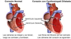 cardiomiopatia