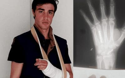 El Hospital Fremap de Majadahonda implanta tornillos de titanio en la mano izquierda del torero Alejandro Gardel
