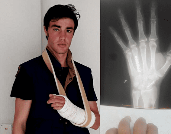 El Hospital Fremap de Majadahonda implanta tornillos de titanio en la mano izquierda del torero Alejandro Gardel
