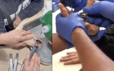 Seis médicos de Majadahonda califican de «rara» la lesión de un cordobés que llamó a los bomberos porque un anillo le estranguló el dedo