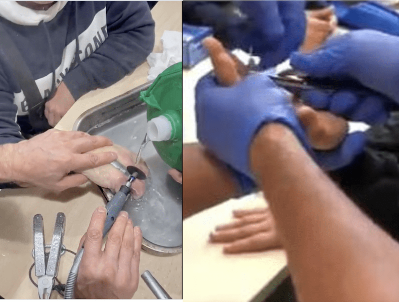 Seis médicos de Majadahonda califican de «rara» la lesión de un cordobés que llamó a los bomberos porque un anillo le estranguló el dedo