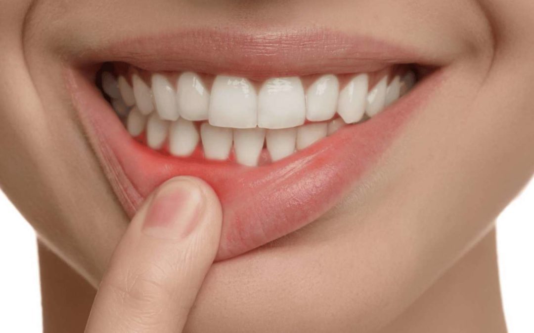 La Clínica Dental Ruiz de Gopegui explica cómo tratar la gingivitis