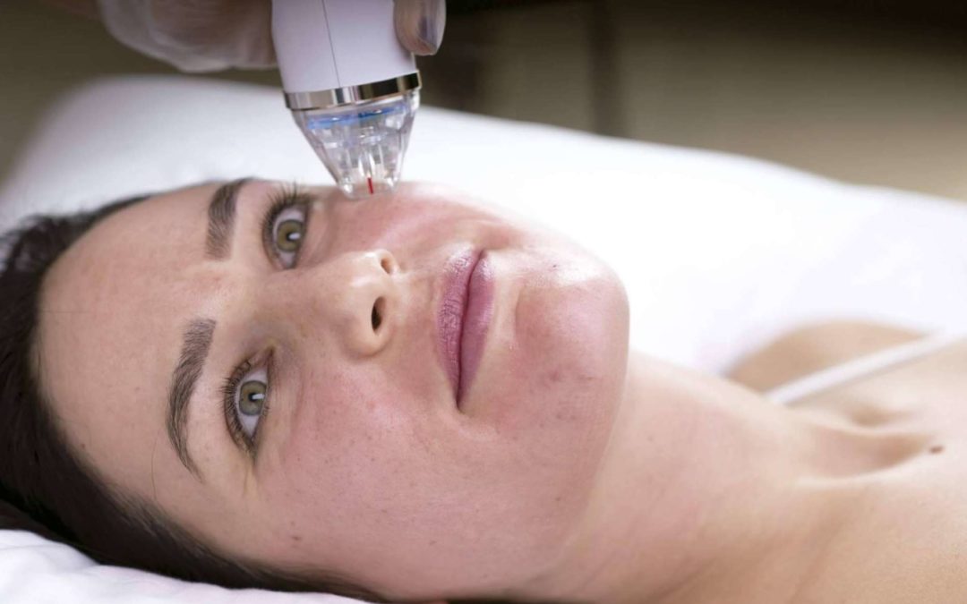 Mejorar la piel del rostro es posible con la técnica de resurfacing facial de Alluring Clinic