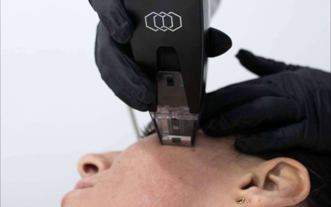 La Clínica BK ofrece un el tratamiento rejuvenecedor Morpheus8 Facial y Corporal