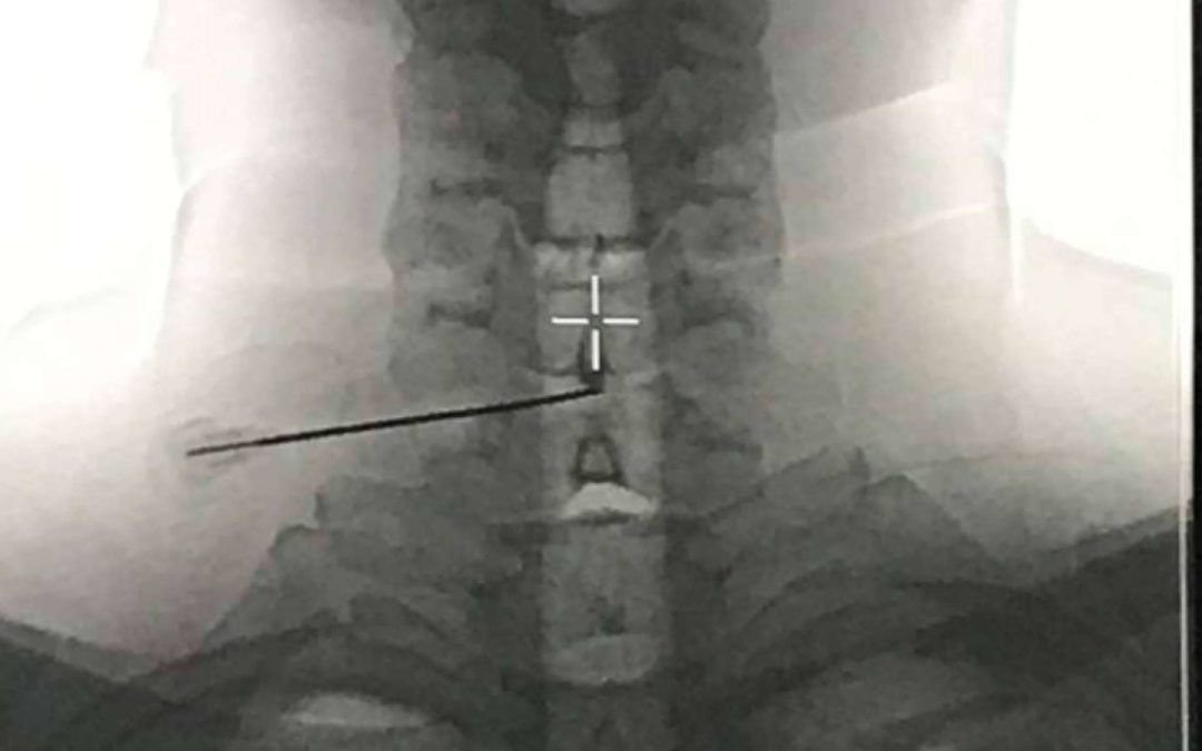 Ozonoterapia para hernia discal; el resultado se mantuvo 10 años después de la disolisis en el 88% de los casos