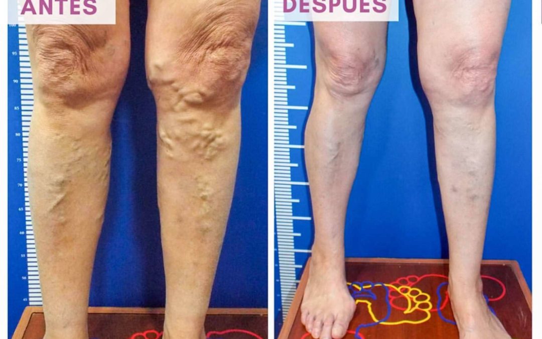 Eliminación de varices sin cirugía