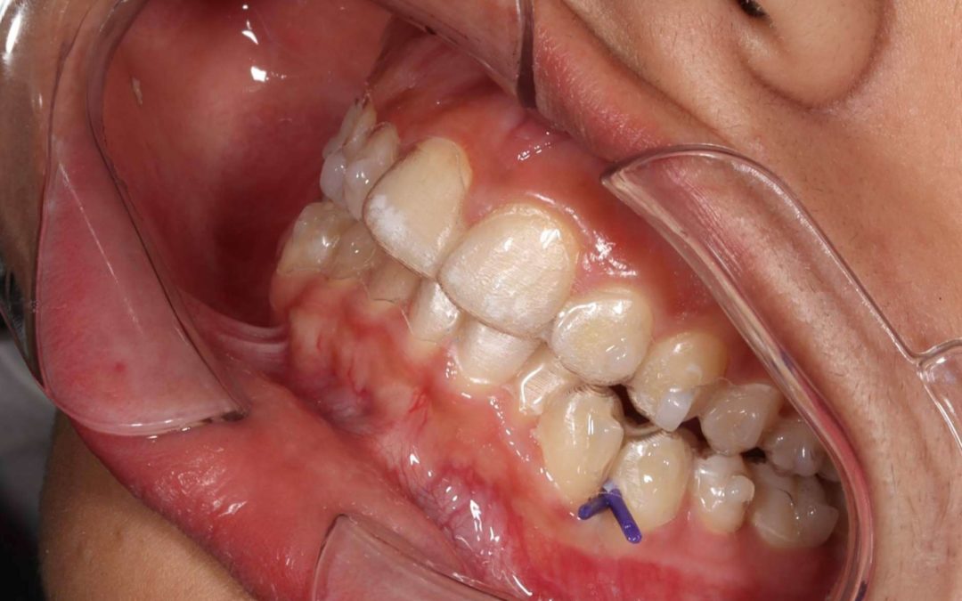 El 56% de las personas tienen miedo a ponerse ortodoncia