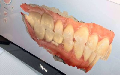 Clínicas Nobel incorpora simulaciones dentales y tecnología avanzada para una experiencia personalizada