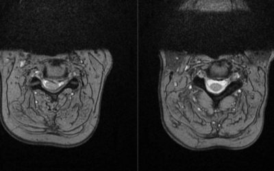 Tratamiento de la hernia discal cervical