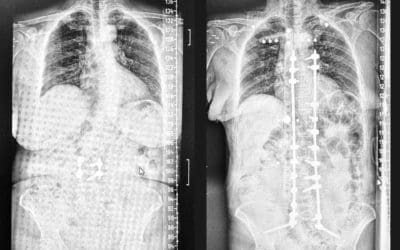 La revolución 3D en la cirugía de escoliosis en el adulto; entrevista con el Dr. Carlos Botella-Asunción