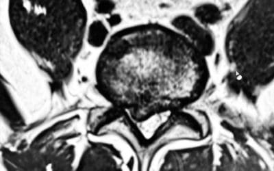 Entrevista al Dr. Botella-Asunción; Microdiscectomía vs. Discectomía endoscópica en la hernia discal lumbar