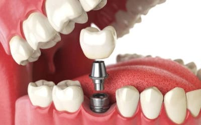 Cómo se coloca un implante dental en Málaga; Paso a paso sin dolor