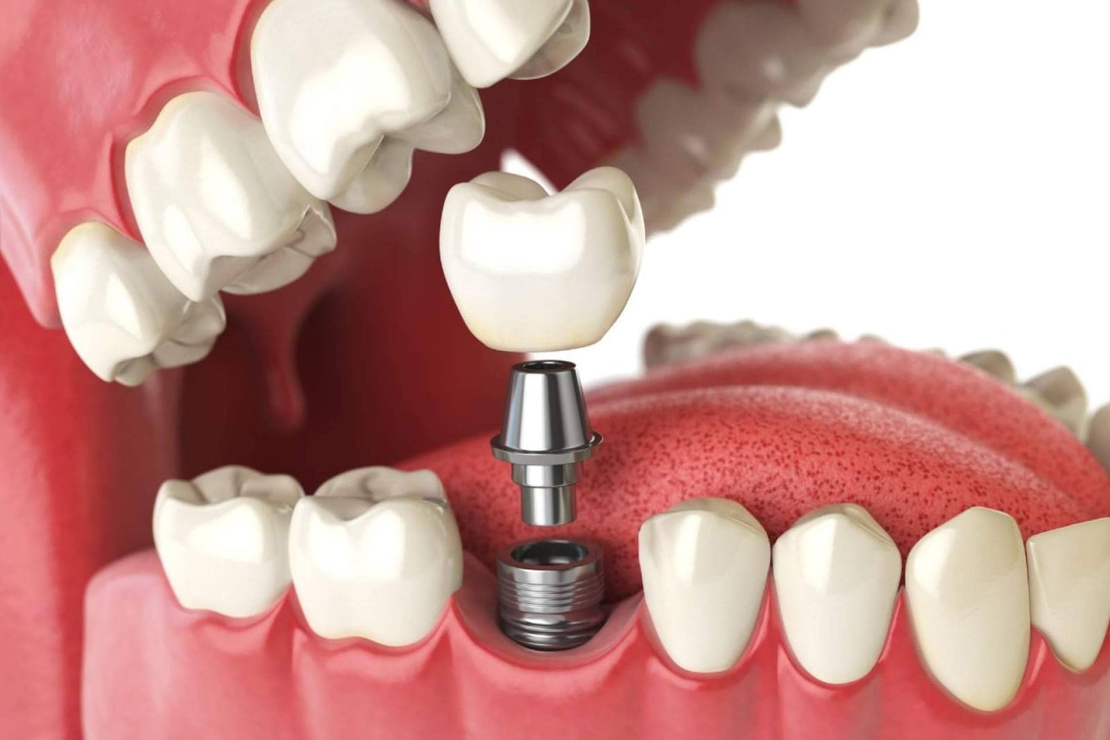Cómo se coloca un implante dental en Málaga; Paso a paso sin dolor